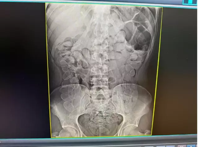 Mula do tráfico em perigo! Boliviana engole cápsulas de cocaína e tem que ser operada